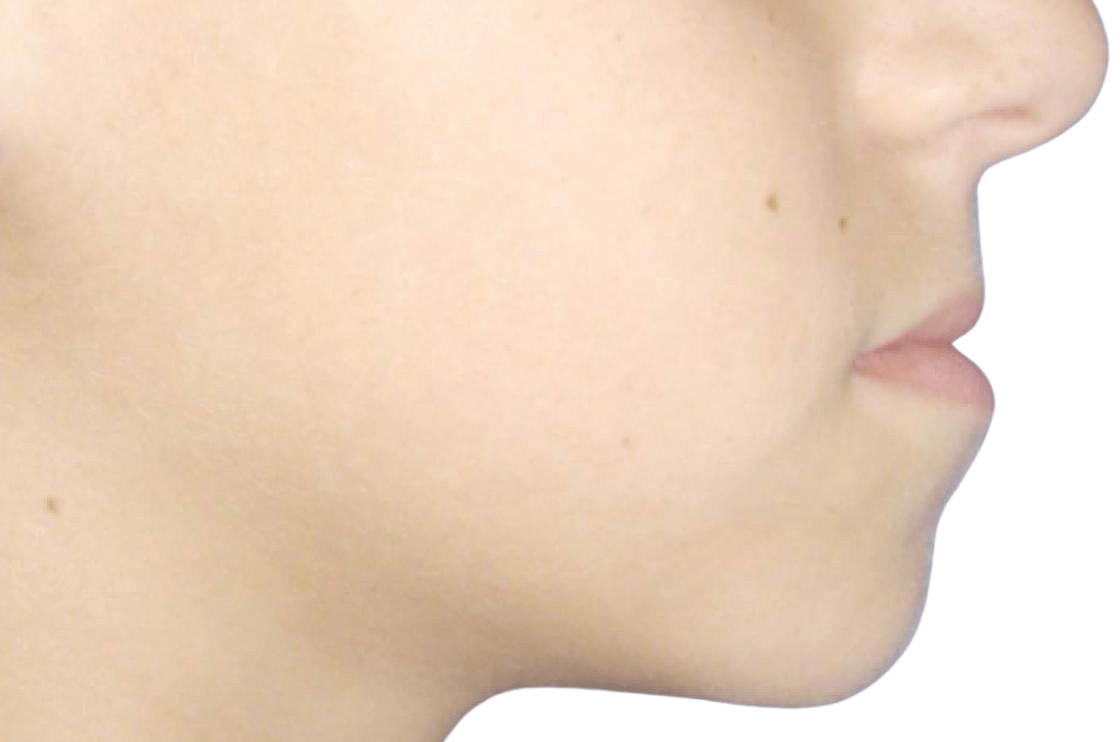 תמונה לפני ניתוח לסתות