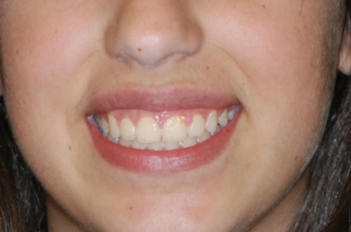 הרחבת חיוך - לפני ואחרי 3