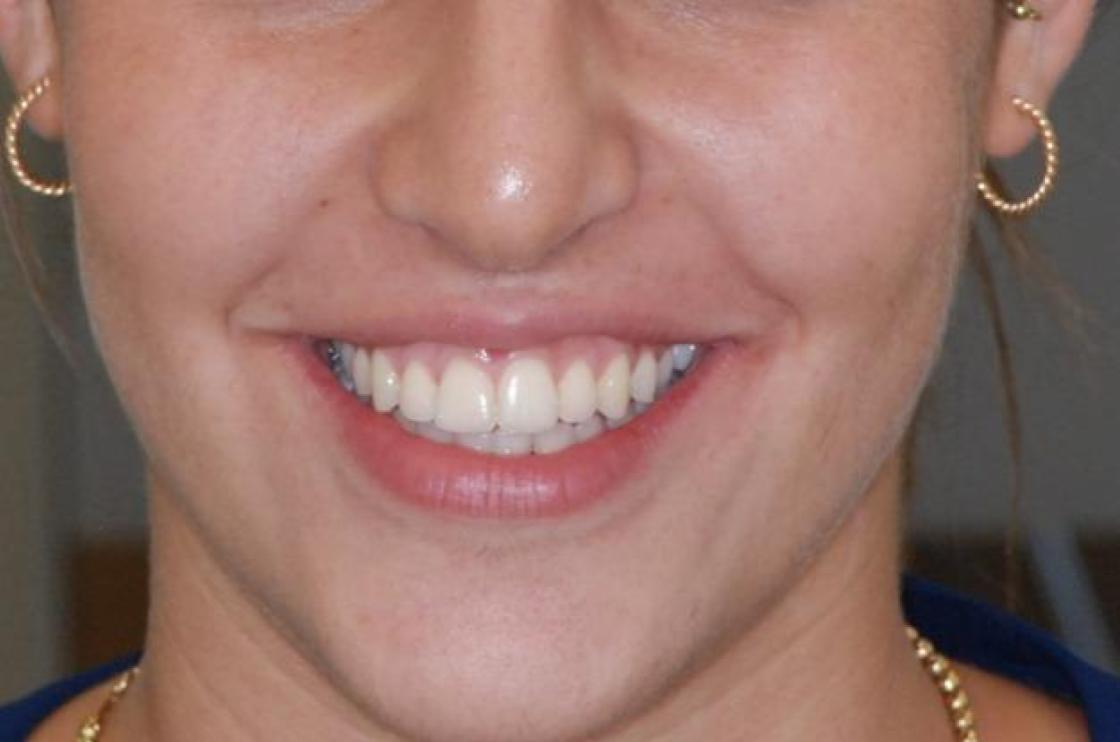 הרחבת חיוך - לפני ואחרי 1