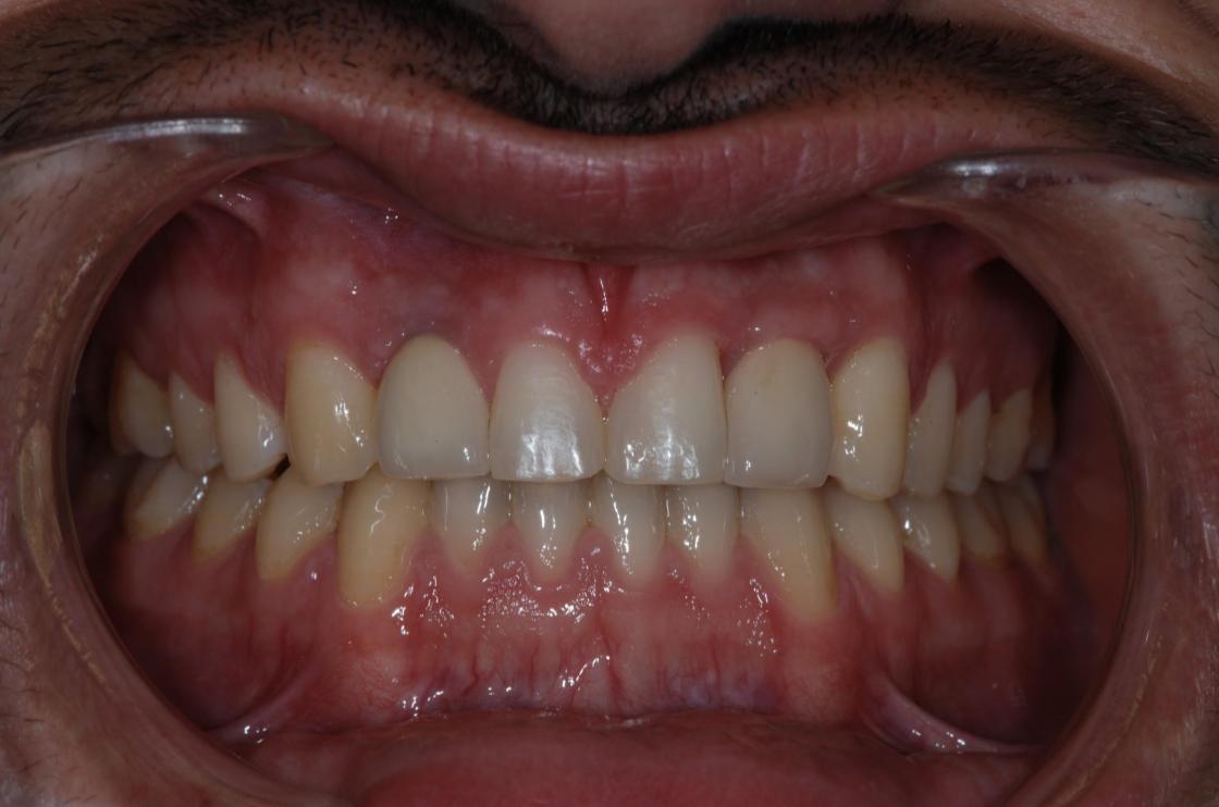 טיפול חסר שיניים - לפני ואחרי 1