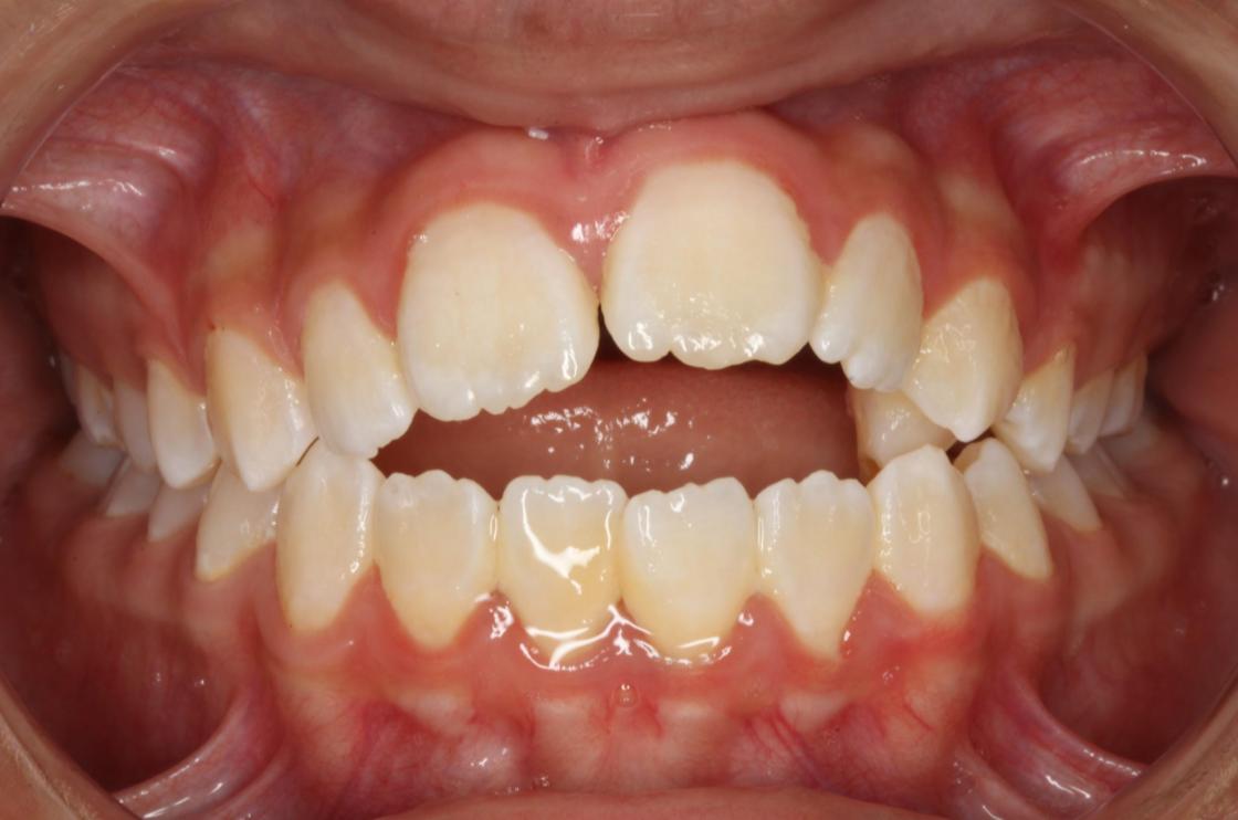 הפסקת מציצת אצבע - לפני ואחרי 2