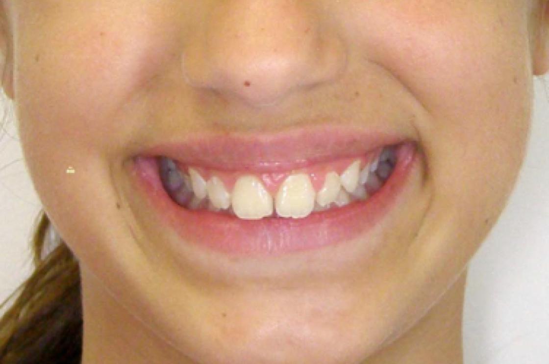 הרחבת חיוך - לפני ואחרי 4