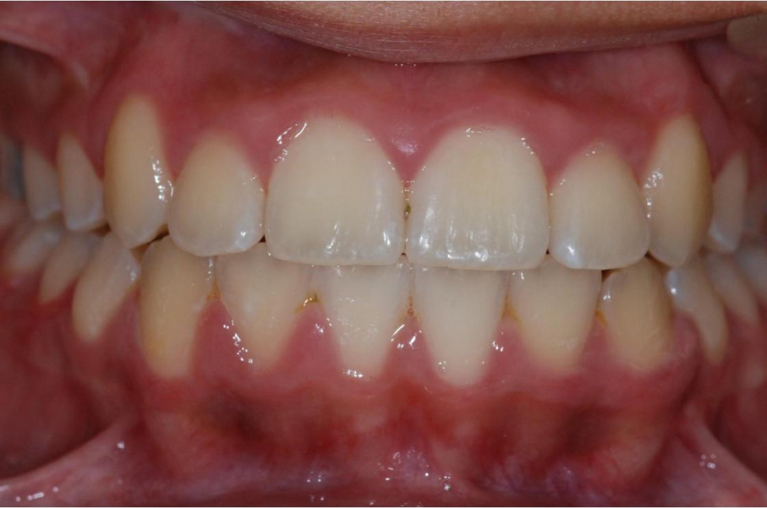 טיפול שיניים צפופות ללא עקירות - לפני ואחרי 1