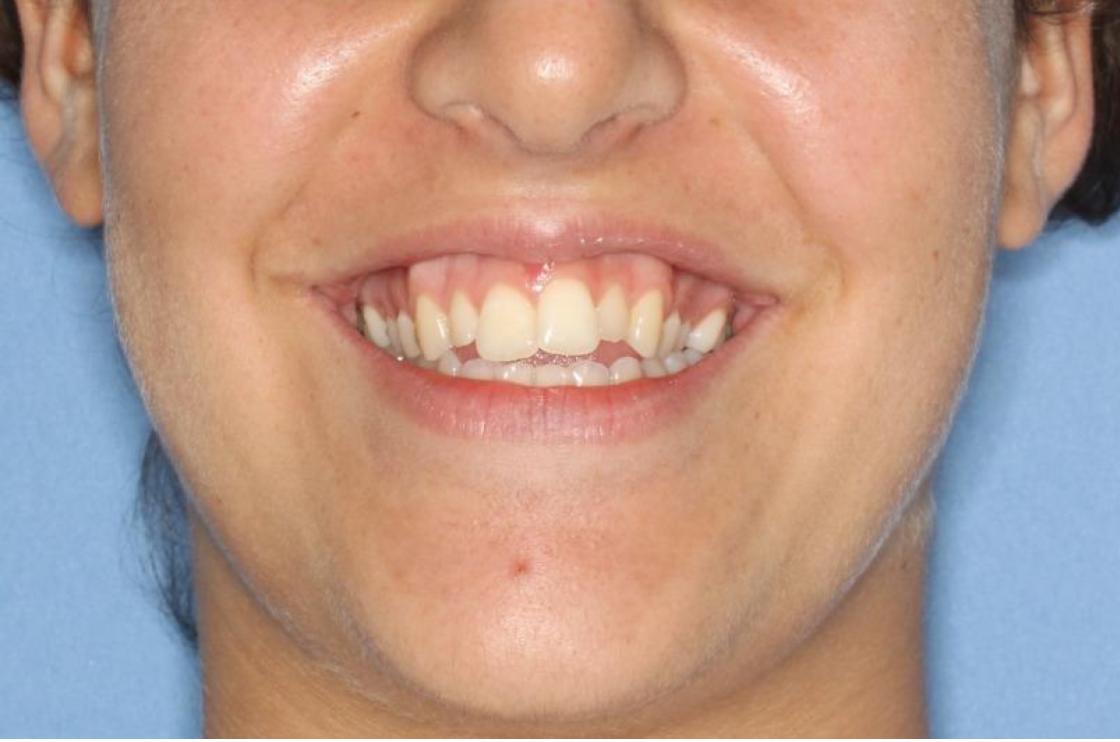 הרחבת חיוך - לפני ואחרי 2